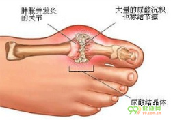 痛风